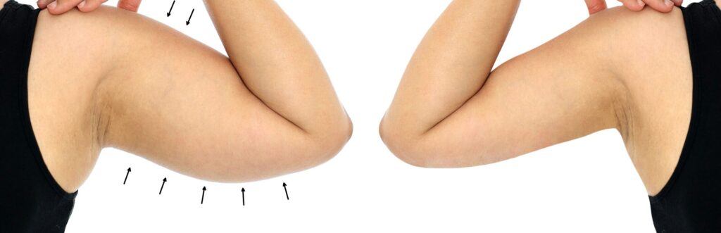 Due to gravity, aging and excessive weight gain and loss, significant changes occur in the upper arm area between the shoulder and the elbow.